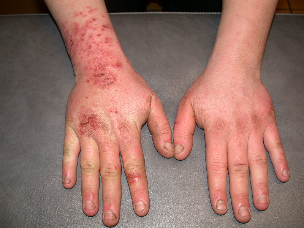 Worker’s Rash & Psychological Disorder Caused by Pesticide Exposure